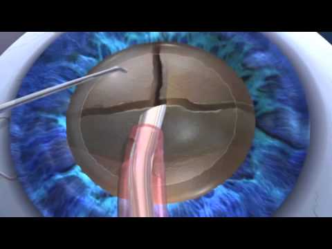 Bloomington, IN | LenSX vs Standard Cataract Surgery | The Eye Center